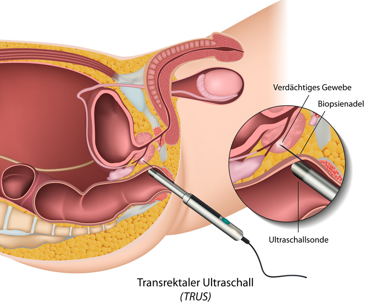 Riscul de cancer de prostata, mai mare la barbatii diagnosticati cu boli inflamatorii intestinale