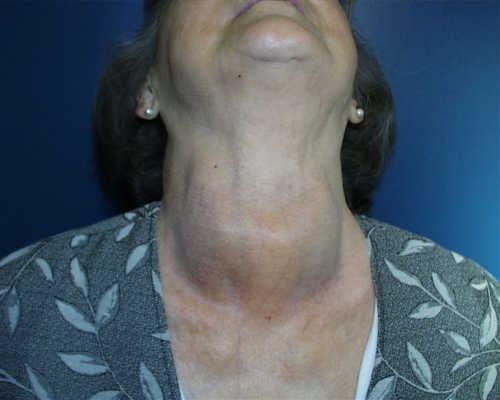 Deutlich sichtbare Schilddrüsenvergrößerung bei zurückgebeugtem Hals
