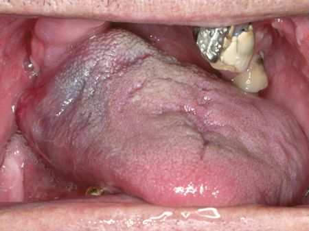 Rachenkrebs an der Zunge